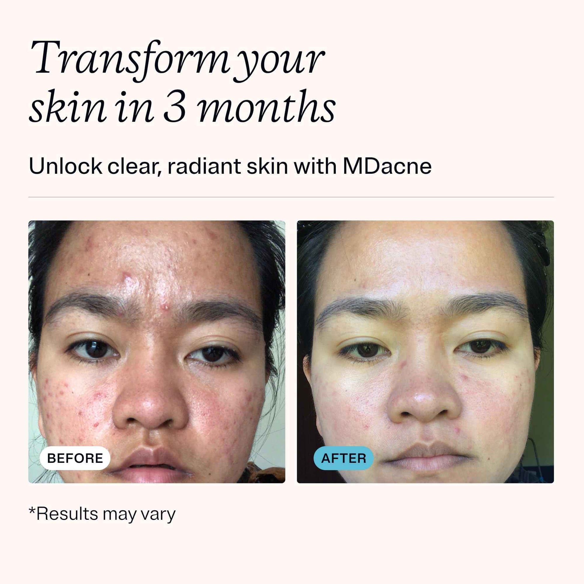 MDacne - Acne Treatment- Benzoyl Peroxide Cream 2.5% - Unclogs Pores, Reduces Blemishes & Enhanced with - Plant-Based Ingredients for Sensitive Skin