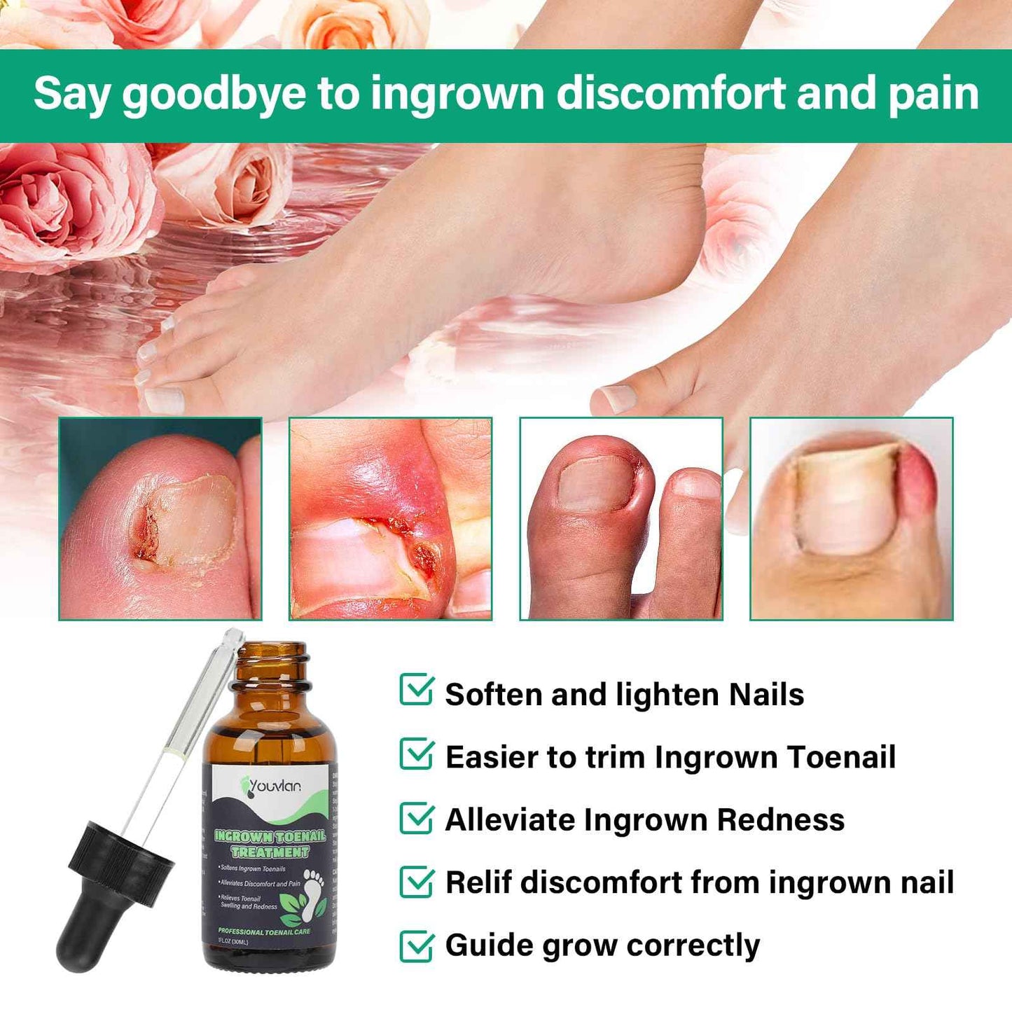 Ingrown Toenail Treatment - Ingrown Toenail Softener Drops,Toenail Lifter,Nail Patches,Best Ingrown Toenail Treatment Kit at Home for Easy Trim Thick Toe Nails Cleaner Tool Kit (Green)