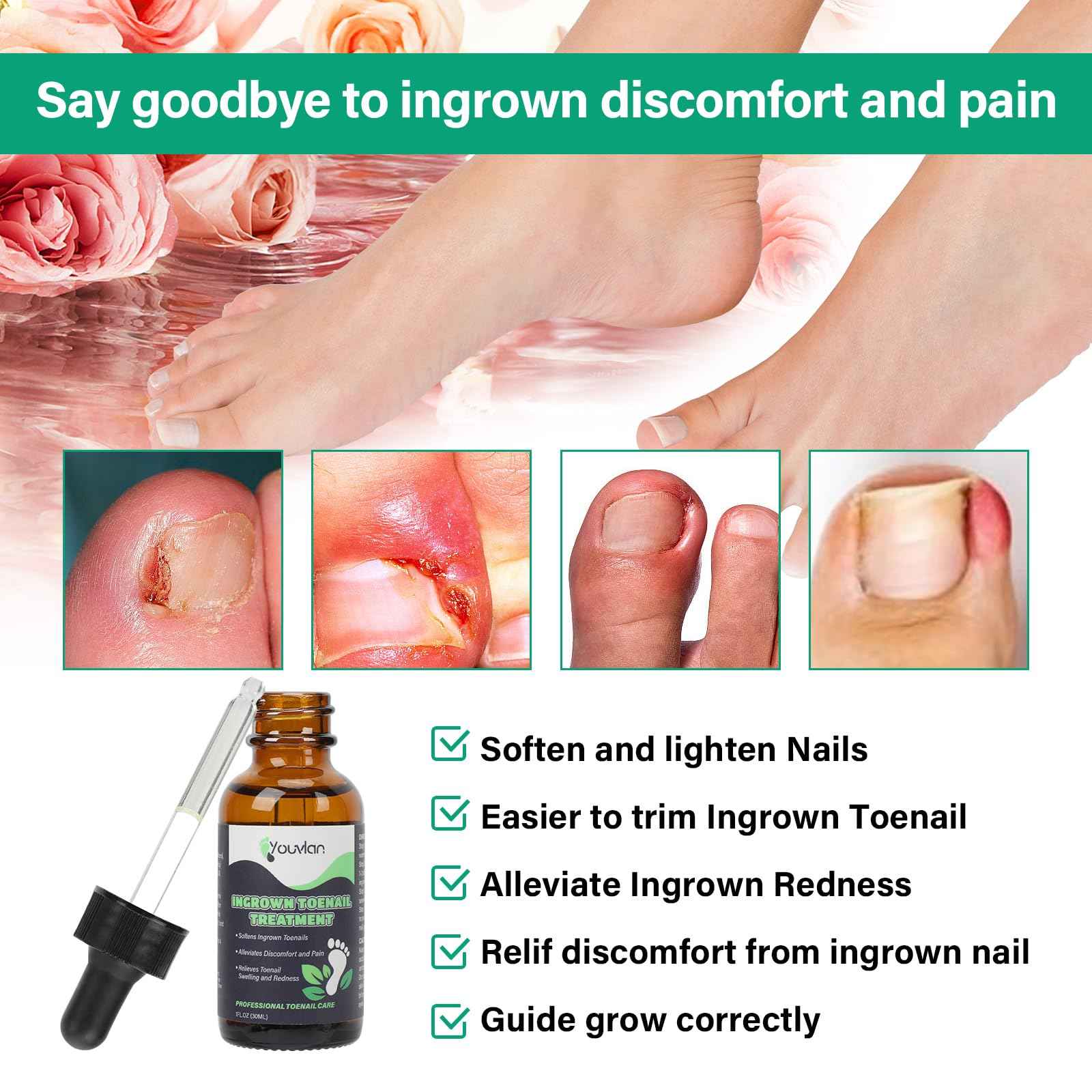 Ingrown Toenail Treatment - Ingrown Toenail Softener Drops,Toenail Lifter,Nail Patches,Best Ingrown Toenail Treatment Kit at Home for Easy Trim Thick Toe Nails Cleaner Tool Kit (Green)