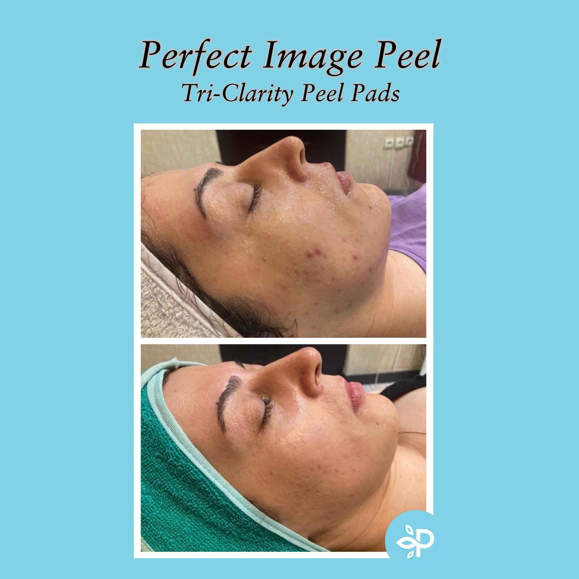 Tri-Clarity Peel Pads, Enhanced with Salicylic Acid, Mandelic Acid, Tea Tree Oil, Green Tea Extract (25% Strength Level)
