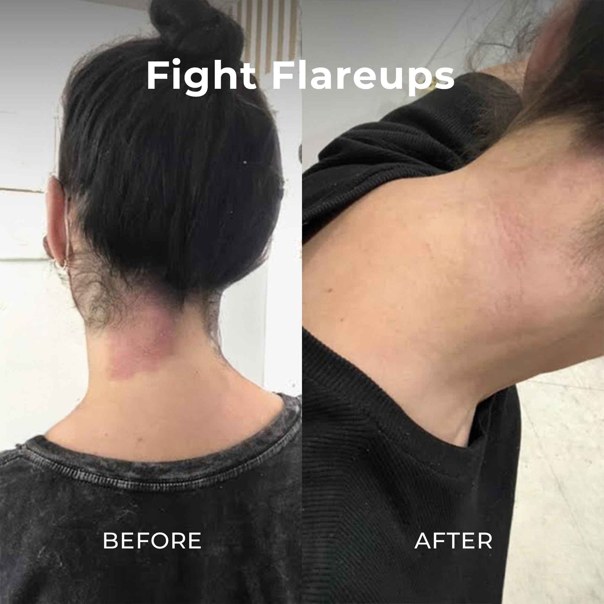 Miami Beach Bum, Bum + Body Cream Daily Moisturizer For Total Skin Health, Body Acne Treatment, Razor Bumps, Keratosis Pilaris, Ingrown Hairs, Sunburns, Blemishes, Orange 6.7 Fl OZ (Pack of 1)