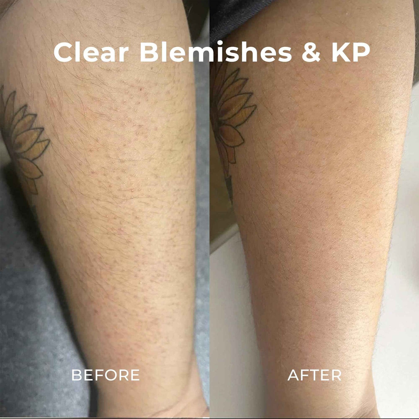 Miami Beach Bum, Bum + Body Cream Daily Moisturizer For Total Skin Health, Body Acne Treatment, Razor Bumps, Keratosis Pilaris, Ingrown Hairs, Sunburns, Blemishes, Orange 6.7 Fl OZ (Pack of 1)