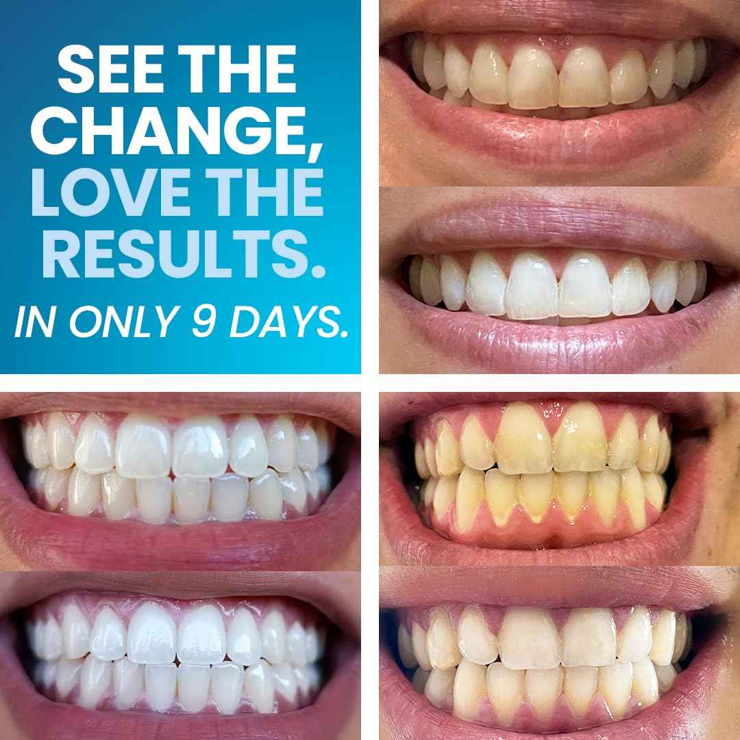 Emerawhite Teeth Whitening Kit - Personalized 9-Day Tooth Whitener - Professional Snow Whitening for Radiant Smiles | Enamel Safe