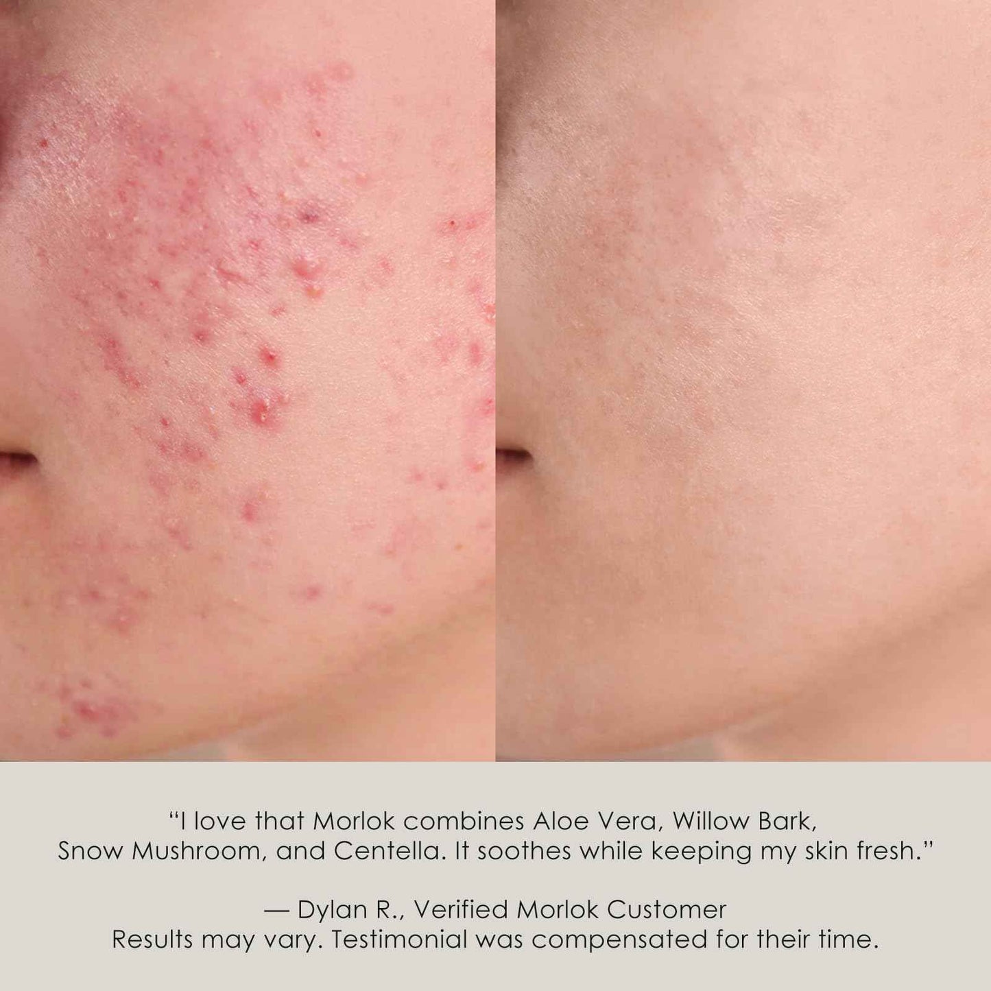 Korean Universal Flare Care Ointment for Sensitive, Irritated or Itchy Skin | Soothing Drawing Salve for Boil-Prone, Chafed & Stressed Areas | Calming Skin Balm with All-Plant Ingredients,1.06 Oz