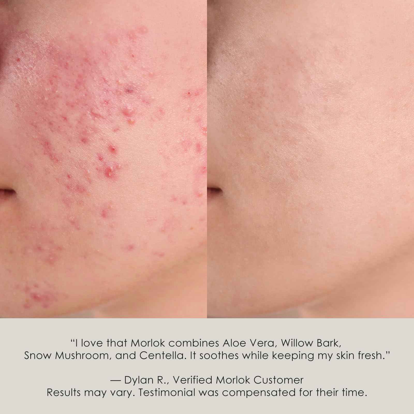 Korean Universal Flare Care Ointment for Sensitive, Irritated or Itchy Skin | Soothing Drawing Salve for Boil-Prone, Chafed & Stressed Areas | Calming Skin Balm with All-Plant Ingredients,1.06 Oz