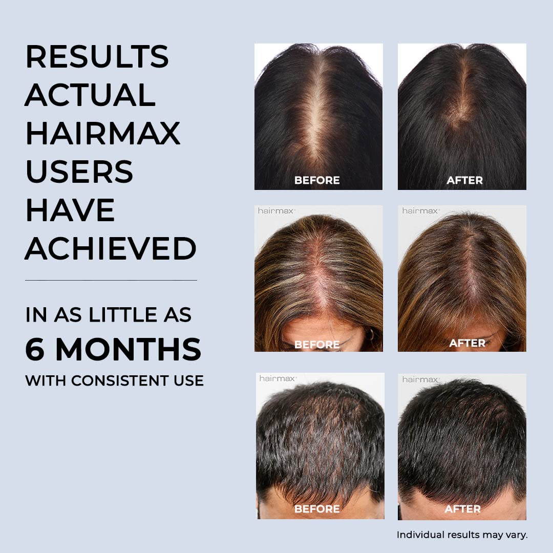 Hairmax Hair Growth Laser Band (FDA Cleared), LaserBand 82 ComfortFlex, Full/Partial Coverage, Hair Growth for Men & Hair Regrowth for Women, Hair Laser Growth, (100% Medical Grade Lasers, Not LEDs)