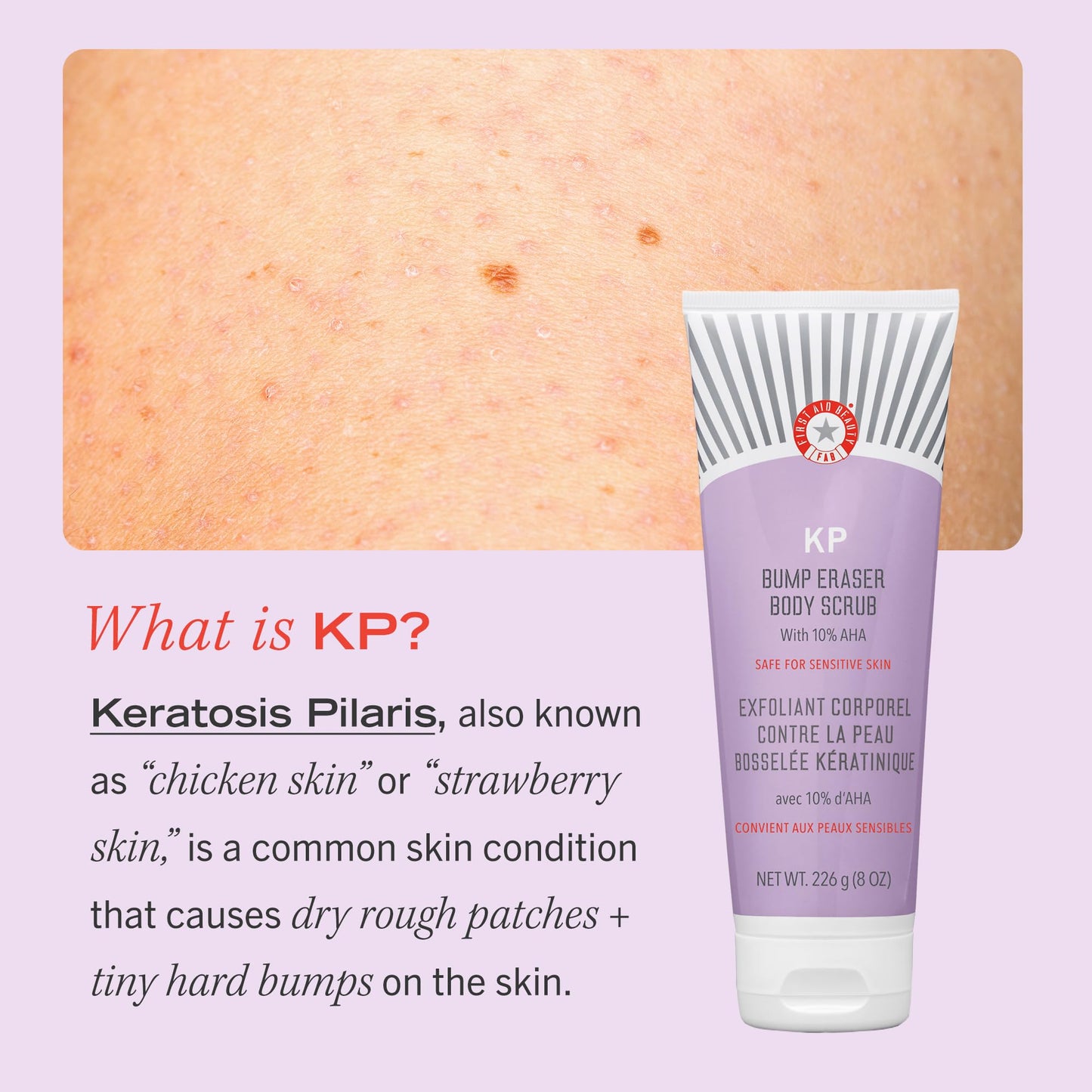 First Aid Beauty KP Bump Eraser Body Scrub Exfoliant for Keratosis Pilaris with 10% AHA 4 oz.