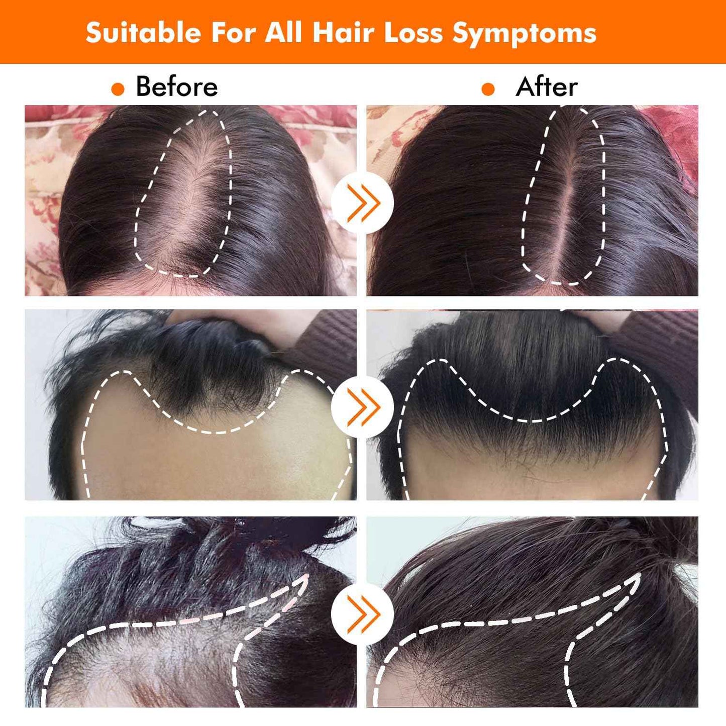 KIRUBRET Hair Growth Kit, Biotin Hair Growth Oil Serum, Hair Scalp Massager Helps absorb Hair Growth Oil Serum