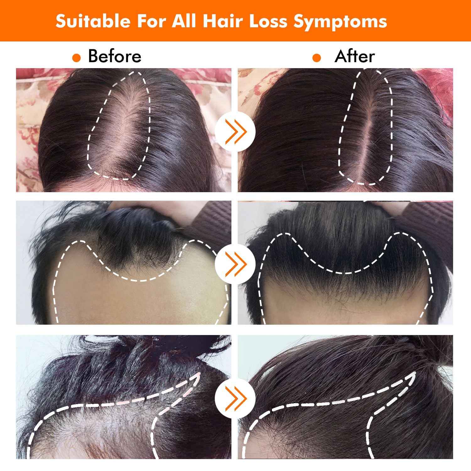 KIRUBRET Hair Growth Kit, Biotin Hair Growth Oil Serum, Hair Scalp Massager Helps absorb Hair Growth Oil Serum