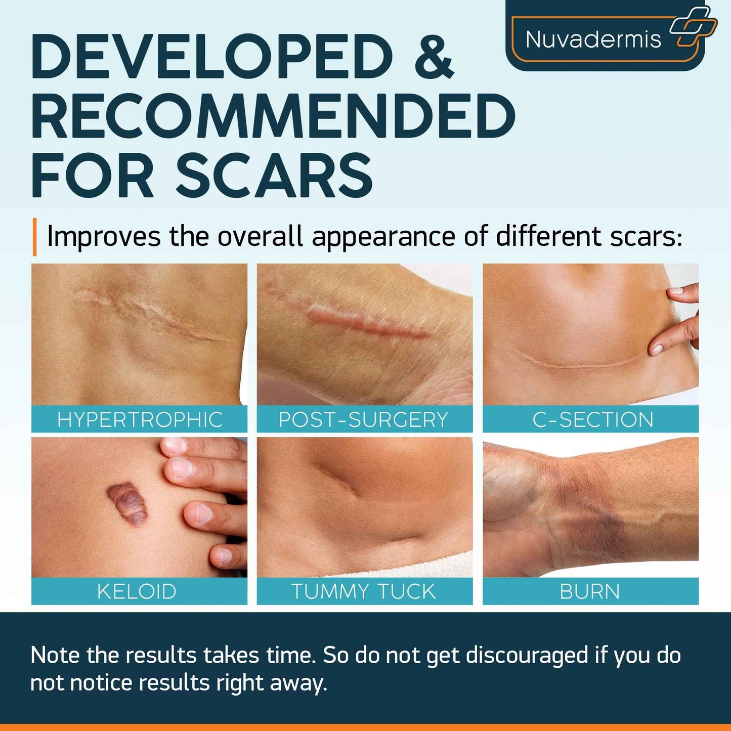 NUVADERMIS Silicone Scar Sheets & Scar Cream Gel - C-Section, Tummy Tuck, Keloid, Acne Removal Treatment - Advanced Post Surgery Supplies - Scars Removal Treatment