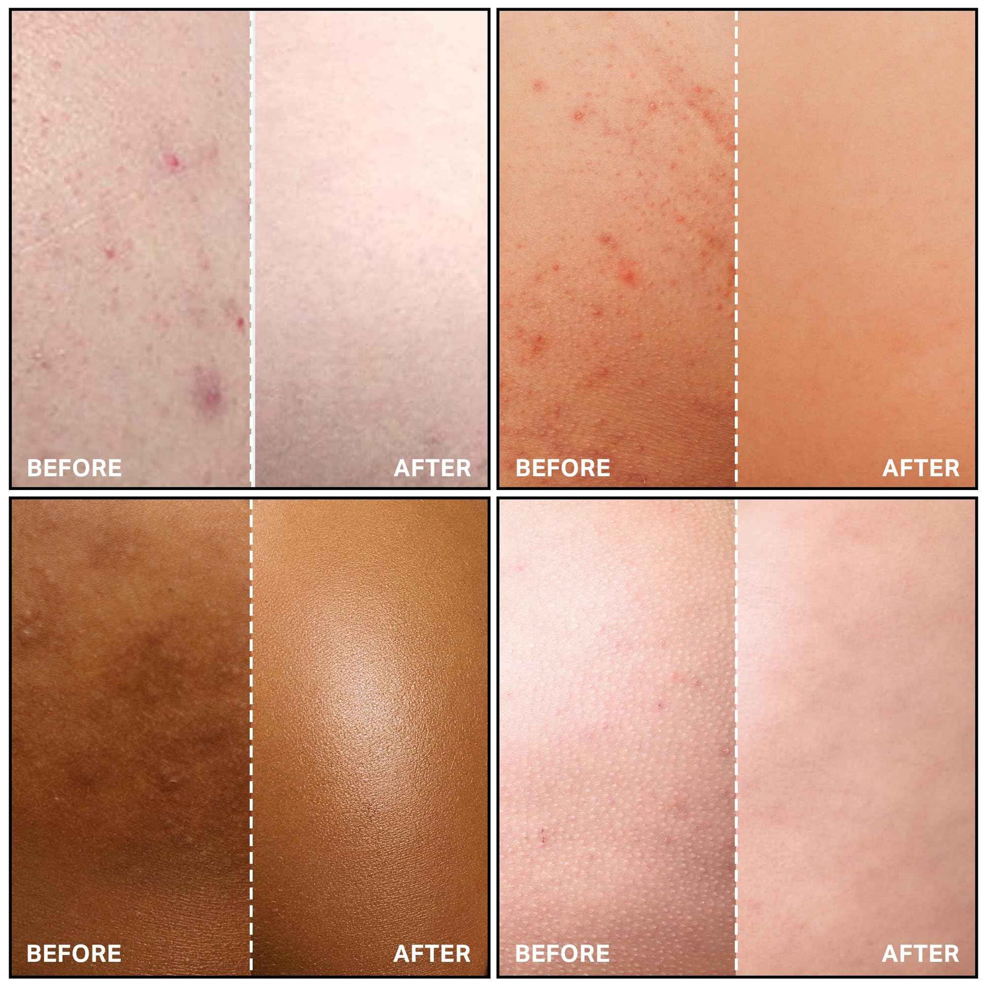 SKIN BOSS Anti-Blemish Body Lotion for Buttne, Back Acne, Inner Thighs & Chest, Targets Folliculitis, Scars & Dark Spots, Daily Use Hydrating Cream for Women & Men of All Skin Types, 5 Oz