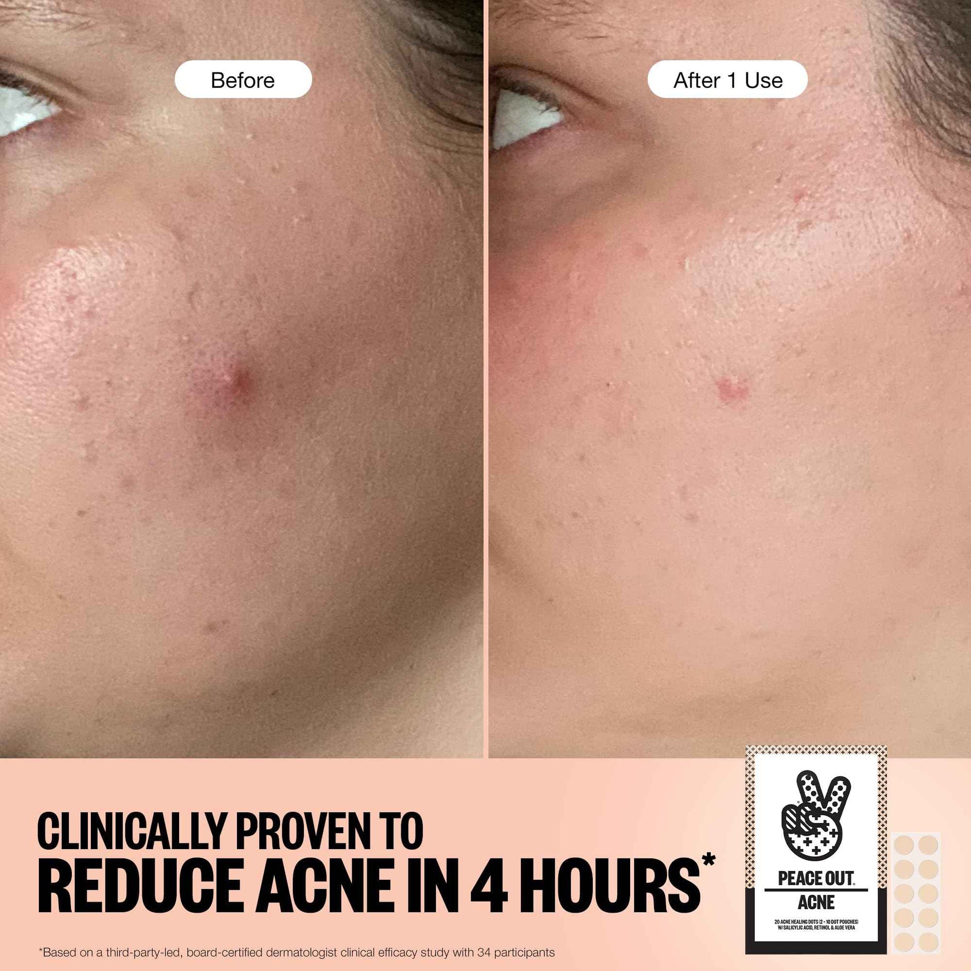 PEACE OUT Acne Healing Dots Helps Clear Blemishes Overnight, Fast Acting Hydrocolloid Pimple Patches for Breakouts with Salicylic Acid, Retinol and Aloe Vera, Award Winning Skincare Solution 60 Count
