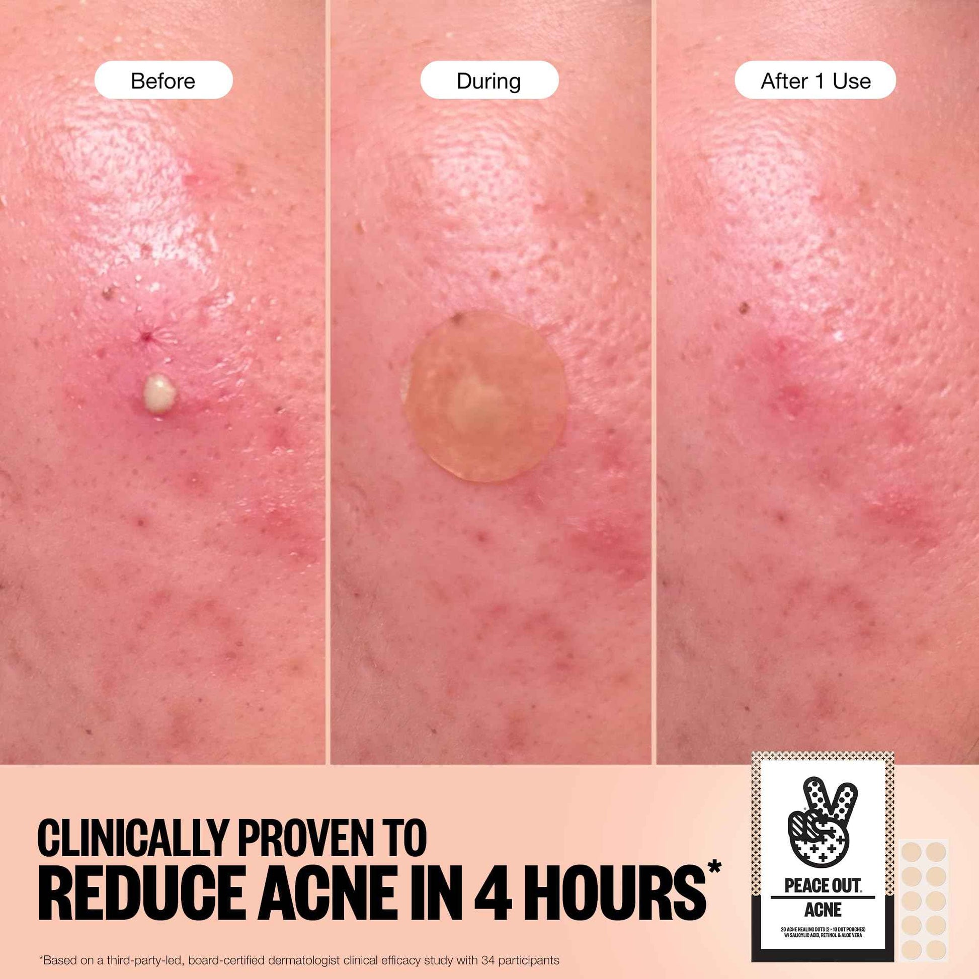 PEACE OUT Acne Healing Dots Helps Clear Blemishes Overnight, Fast Acting Hydrocolloid Pimple Patches for Breakouts with Salicylic Acid, Retinol and Aloe Vera, Award Winning Skincare Solution 60 Count