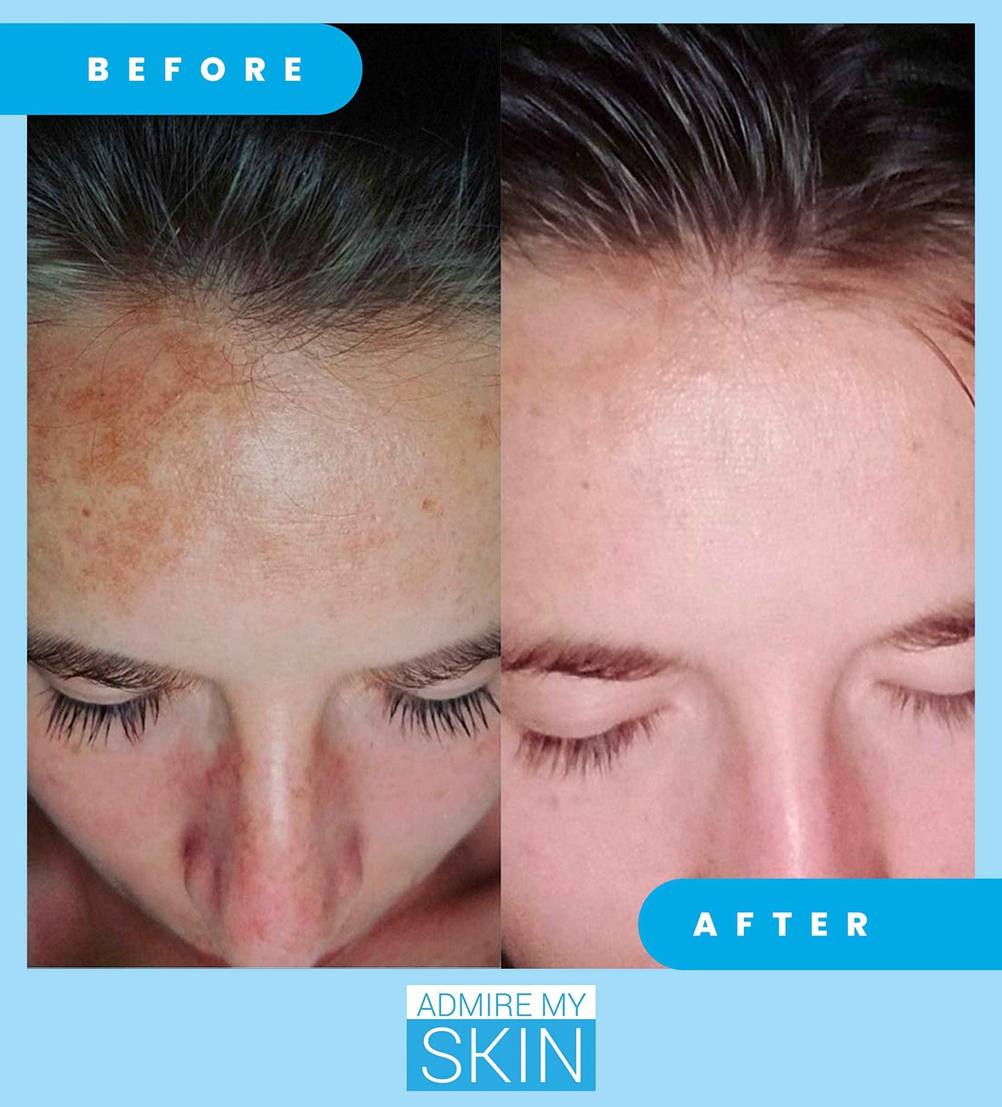 Admire My Skin Dark Spot Corrector Serum + Retinoid Cream Set