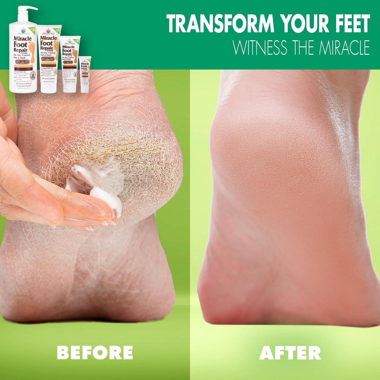 Miracle Foot Repair Cream (8 oz / 3-Pack) Repairs Dry Cracked Heels and Feet, 60% Pure UltraAloe Moisturizes, Softens, and Repairs