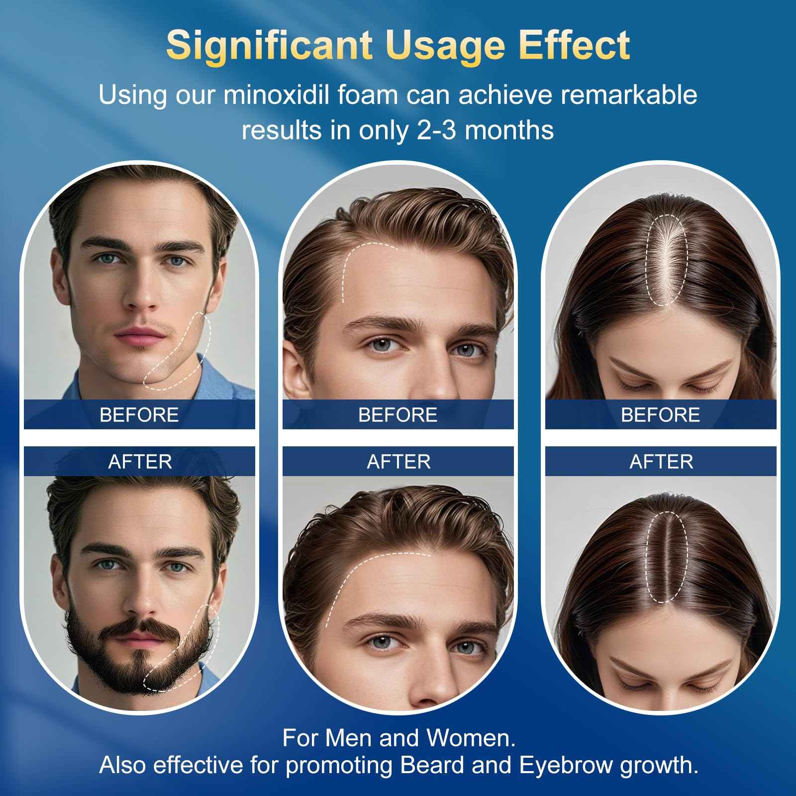 5% minoxidil foam for men-5pack， Infused with Biotin, Hair Growth Treatment, Supports Thicker and Fuller Hair & Beard (10.5oz, 5 Month Supply)