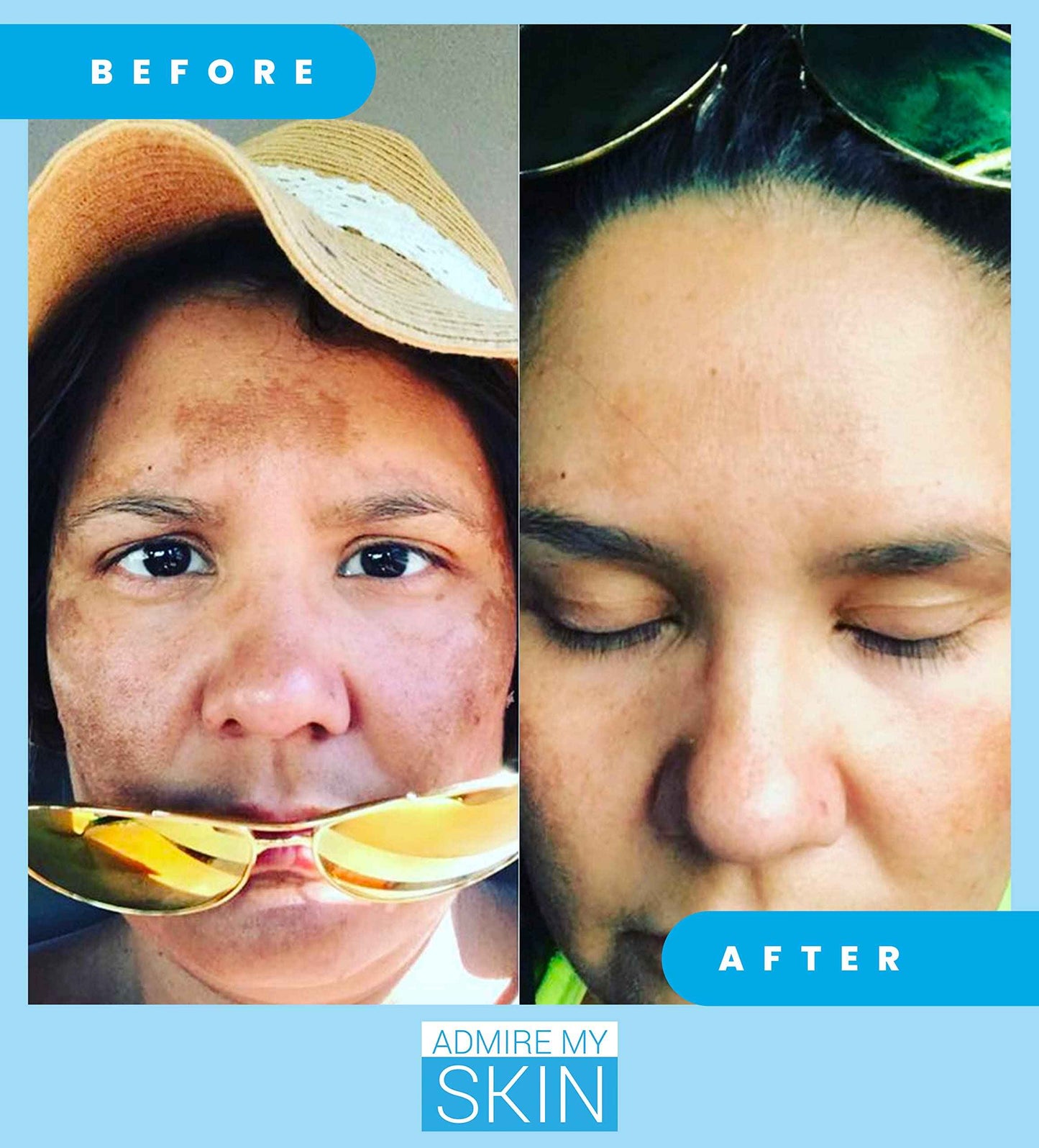 Admire My Skin Dark Spot Corrector Serum + Retinoid Cream Set