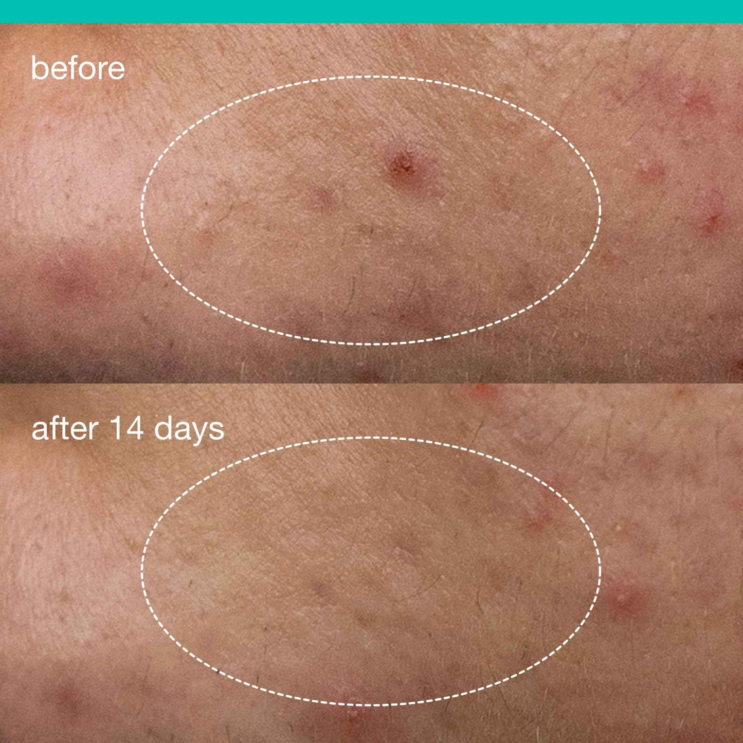 Dermalogica Deep Acne Liquid Patch, Sulfur Acne Treatment with Niacinamide, Invisible Spot Treatment for Blemish-Prone Skin – 0.5 fl oz