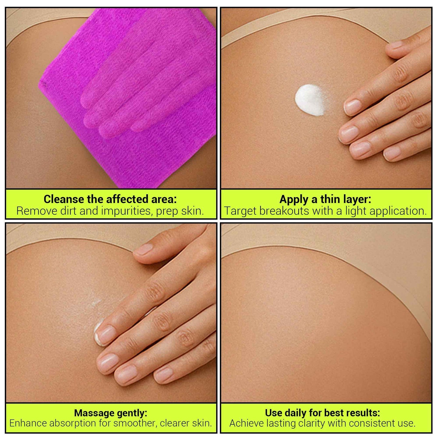 SKIN BOSS Anti-Blemish Body Lotion for Buttne, Back Acne, Inner Thighs & Chest, Targets Folliculitis, Scars & Dark Spots, Daily Use Hydrating Cream for Women & Men of All Skin Types, 5 Oz