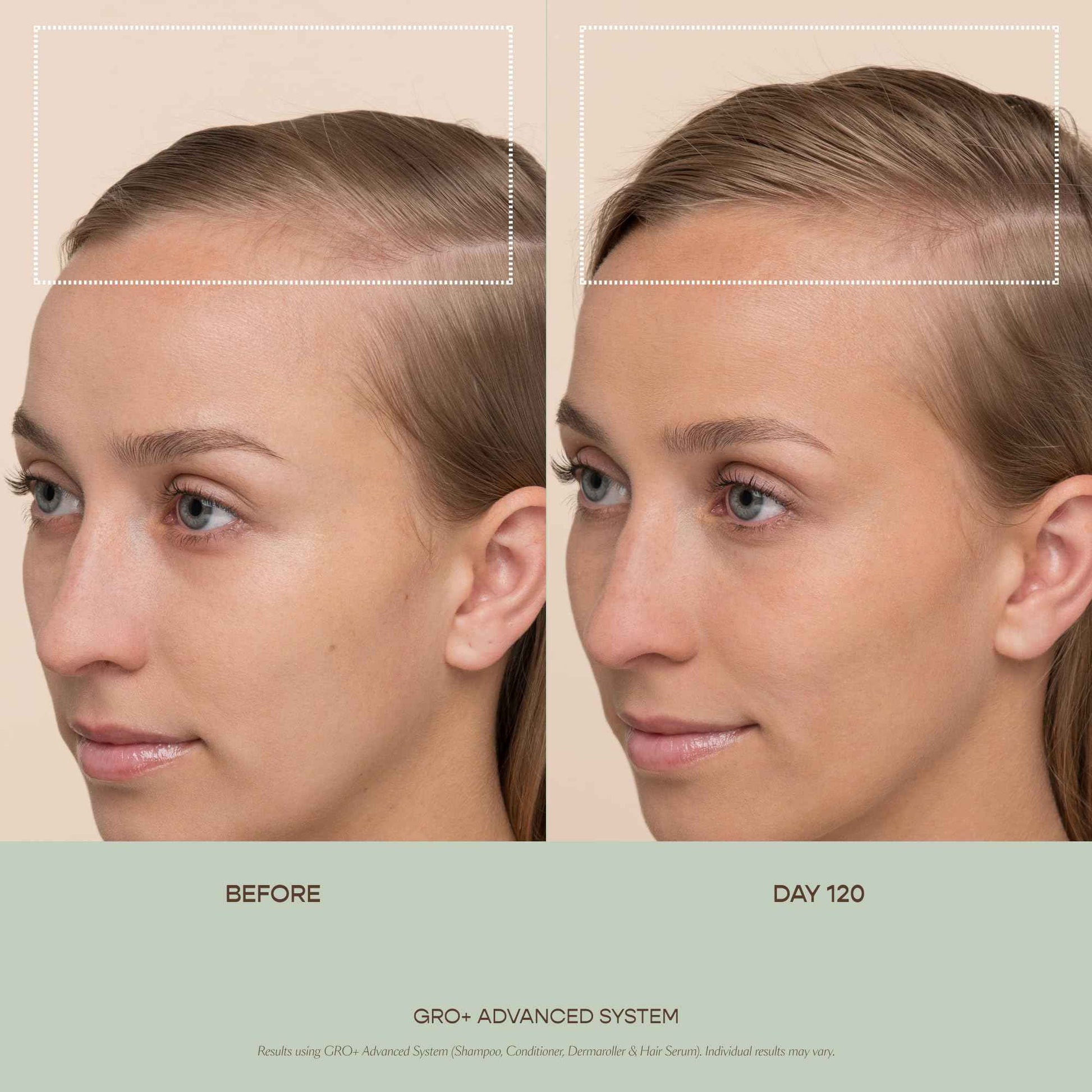 VEGAMOUR GRO+ Advanced Balancing Shampoo | Lightly Exfoliates, Cleanses and Removes Buildup Without Stripping | For Severe Signs of Thinning | Color Safe, Vegan, Cruelty-Free (8 Fl Oz)