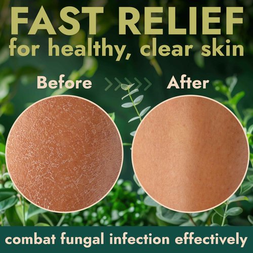 Antibacterial Body Wash | Antifungal Soap for Men & Women | Kills 99.9% of Germs & Bacteria | Helps with Back Acne, Body Odor, Jock Itch & Skin Irritation | Manuka Honey & Charcoal, 16 fl oz