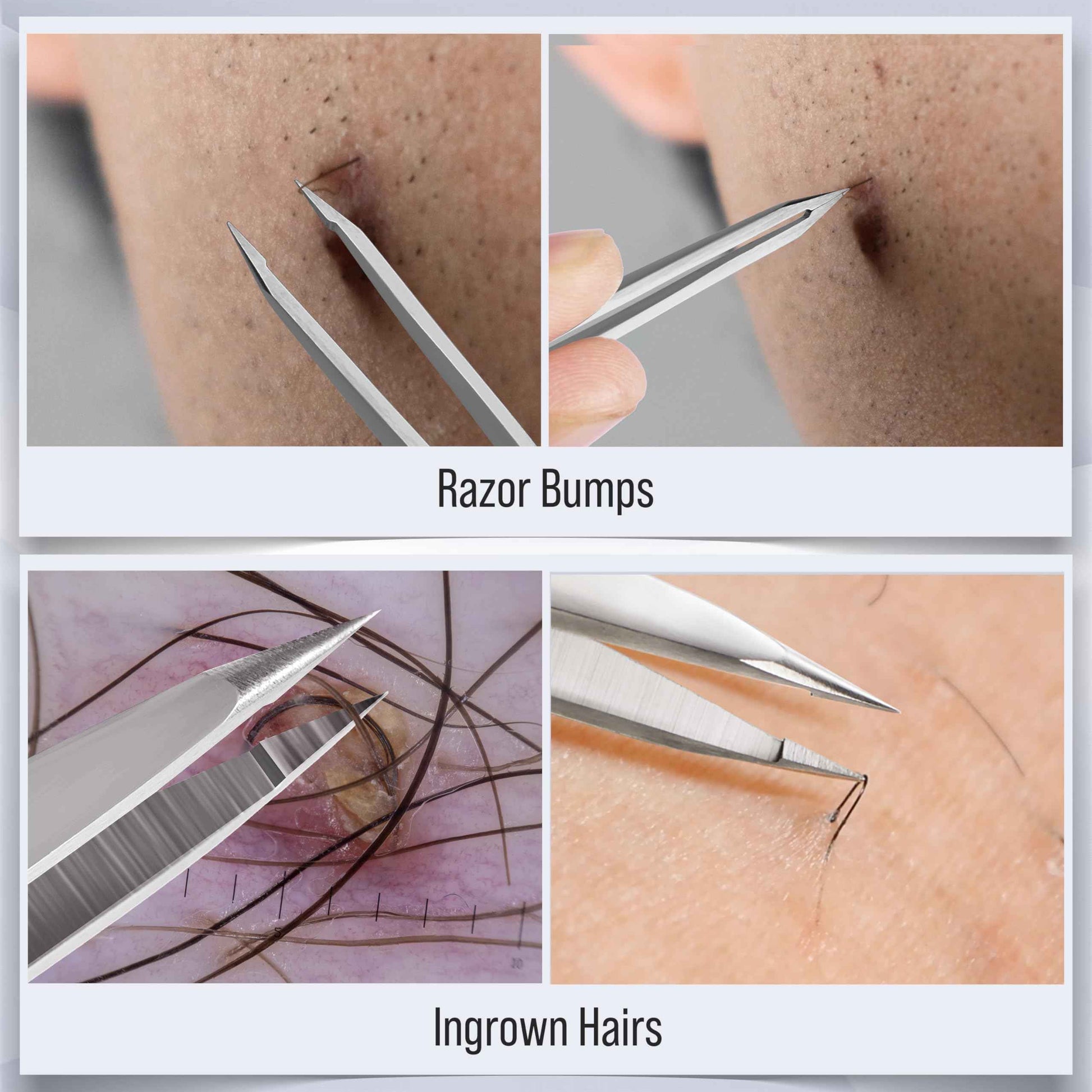 DUROX 3-Piece Tweezer Set — 1.Pointed Ingrown Hair Tweezers, 2.Fine-Tip Splinter Tweezers, 3.Safety Round Tip for Facial & Chin Hair Removal. Made of stainless steel. Protective pouch for safe storage