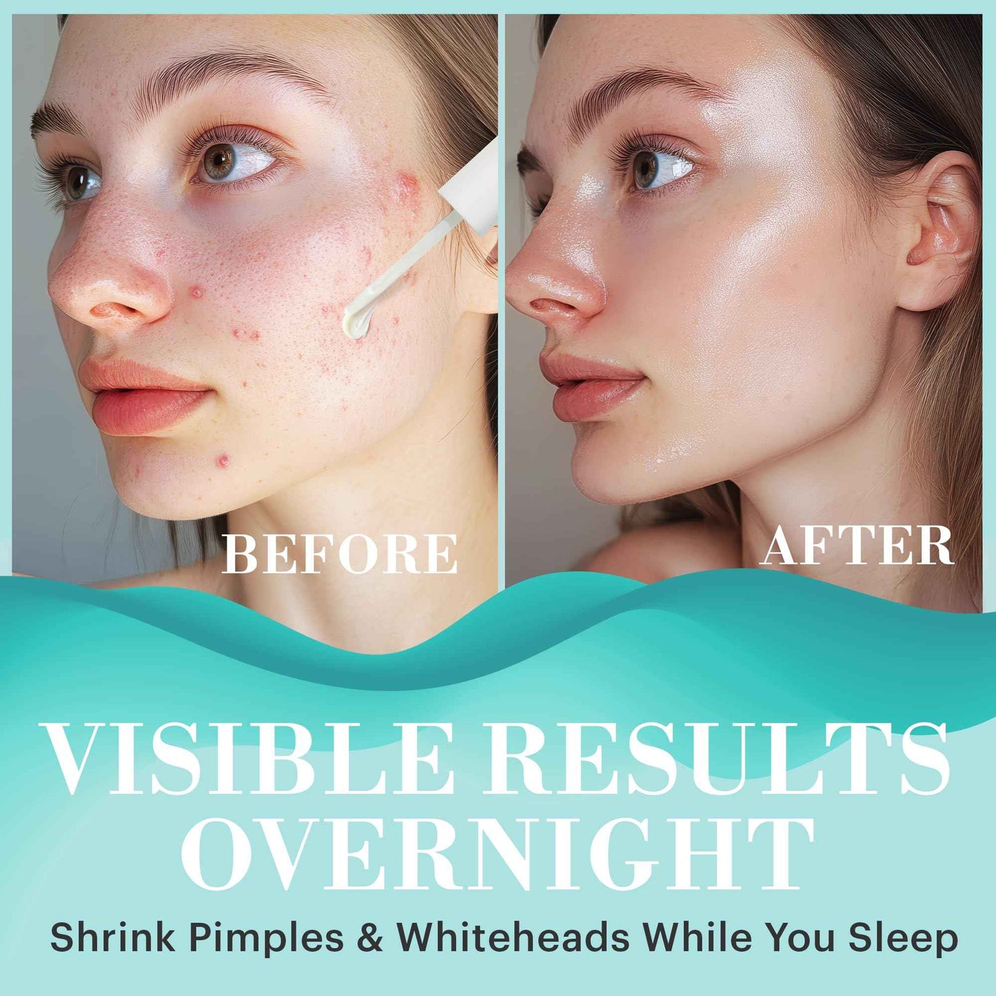 Repechage Drying Lotion Acne Spot Treatment - 0.25 FL Salicylic Acid & Fruit Acid Formula | Rapid Pimple & Blemish Reduction | Overnight Acne Treatment for Teens & Adults