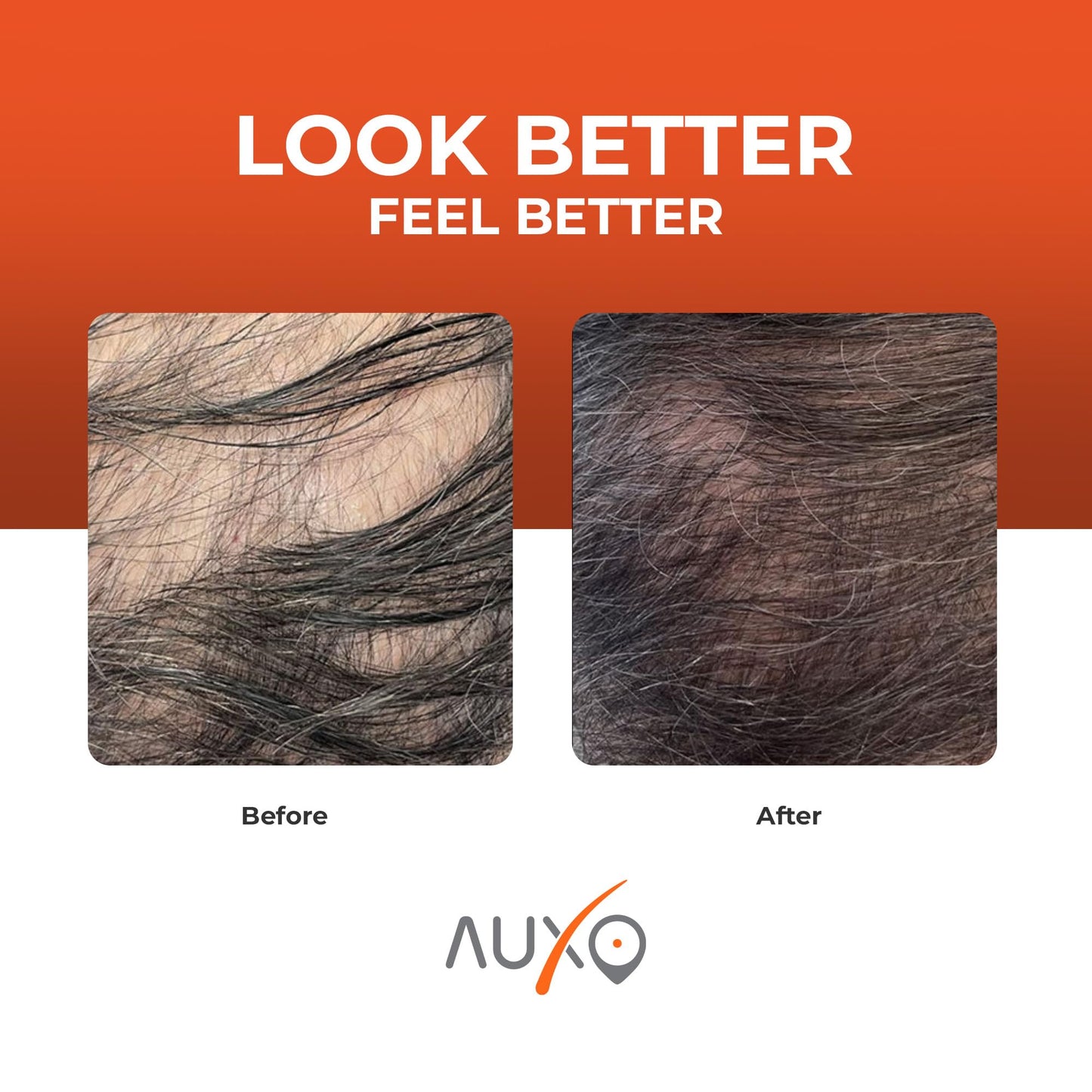 Auxo A150 Hair Growth Red Light Laser Hat For Treatment of Hair Loss due to androgenic alopecia (AgA) For Men Women Hair Regrowth Treatment For Thinning Hair FDA Cleared