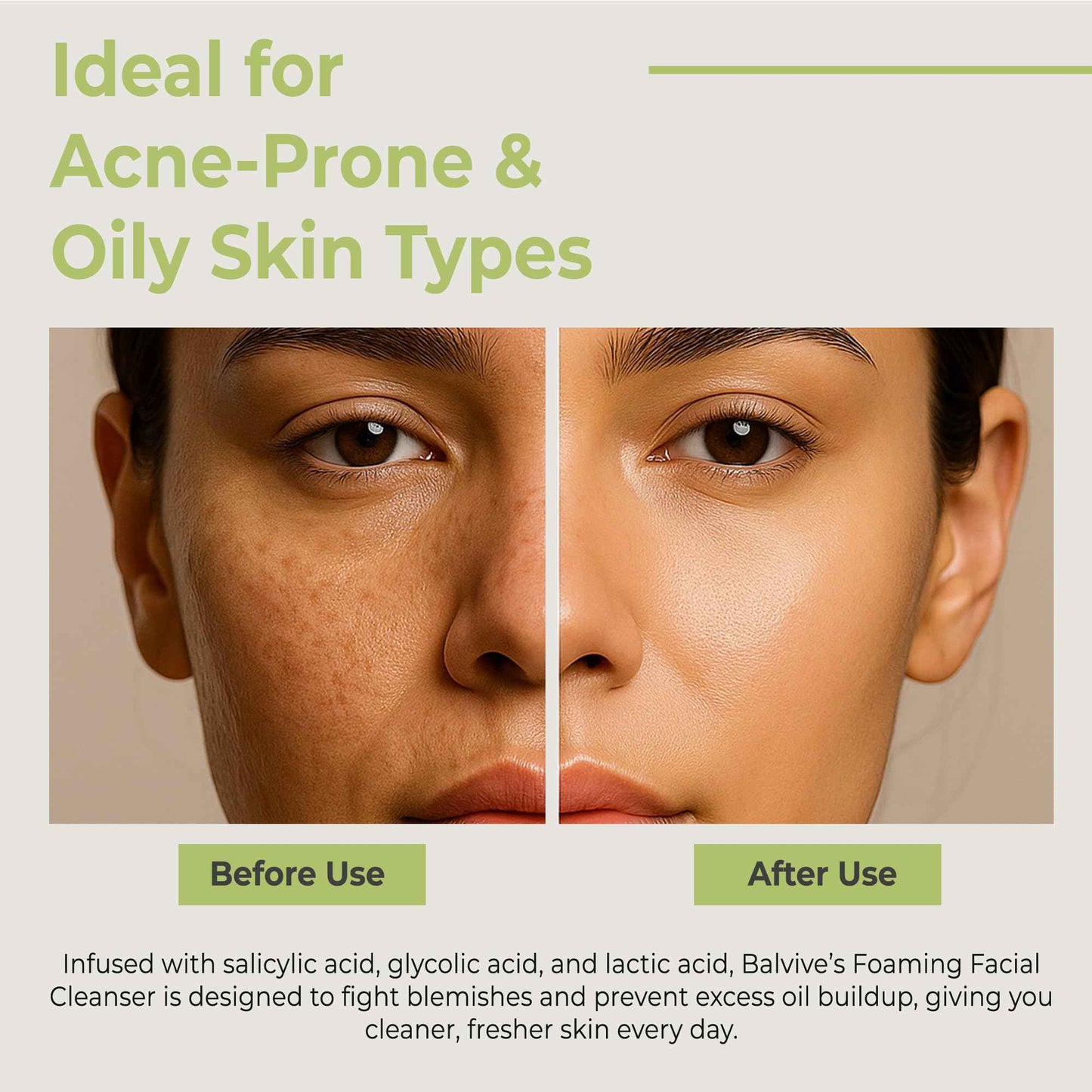 BALVIVE Foaming Facial Cleanser with Salicylic Acid, Glycolic Acid & Lactic Acid & Green Tea Extract– Face Wash for Acne, Oily & Sensitive Skin – Makeup Remover & Pore-Cleansing Skincare 6.7 fl oz