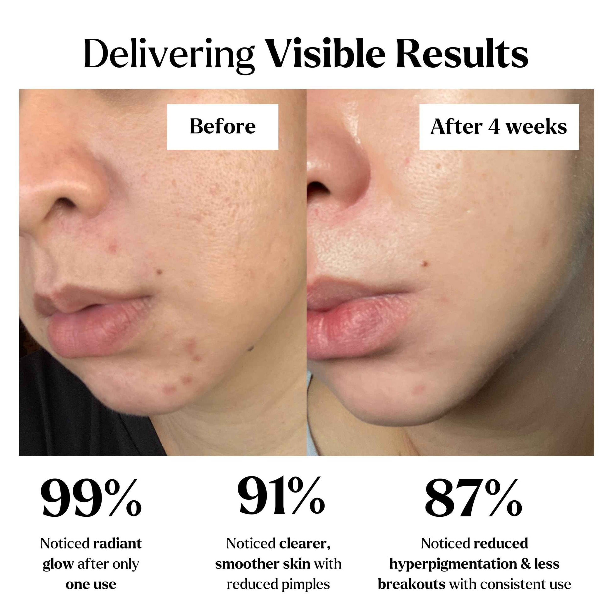 Clay Mask Gift Pack of 4 Jars (400g), Cute Headband & Brush | Clay Face Mask | Turmeric Vitamin C, Green Tea, Rose, Dead Sea Mud | Clay Mask For Face | Christmas Gifts for Women, Gifts for Women