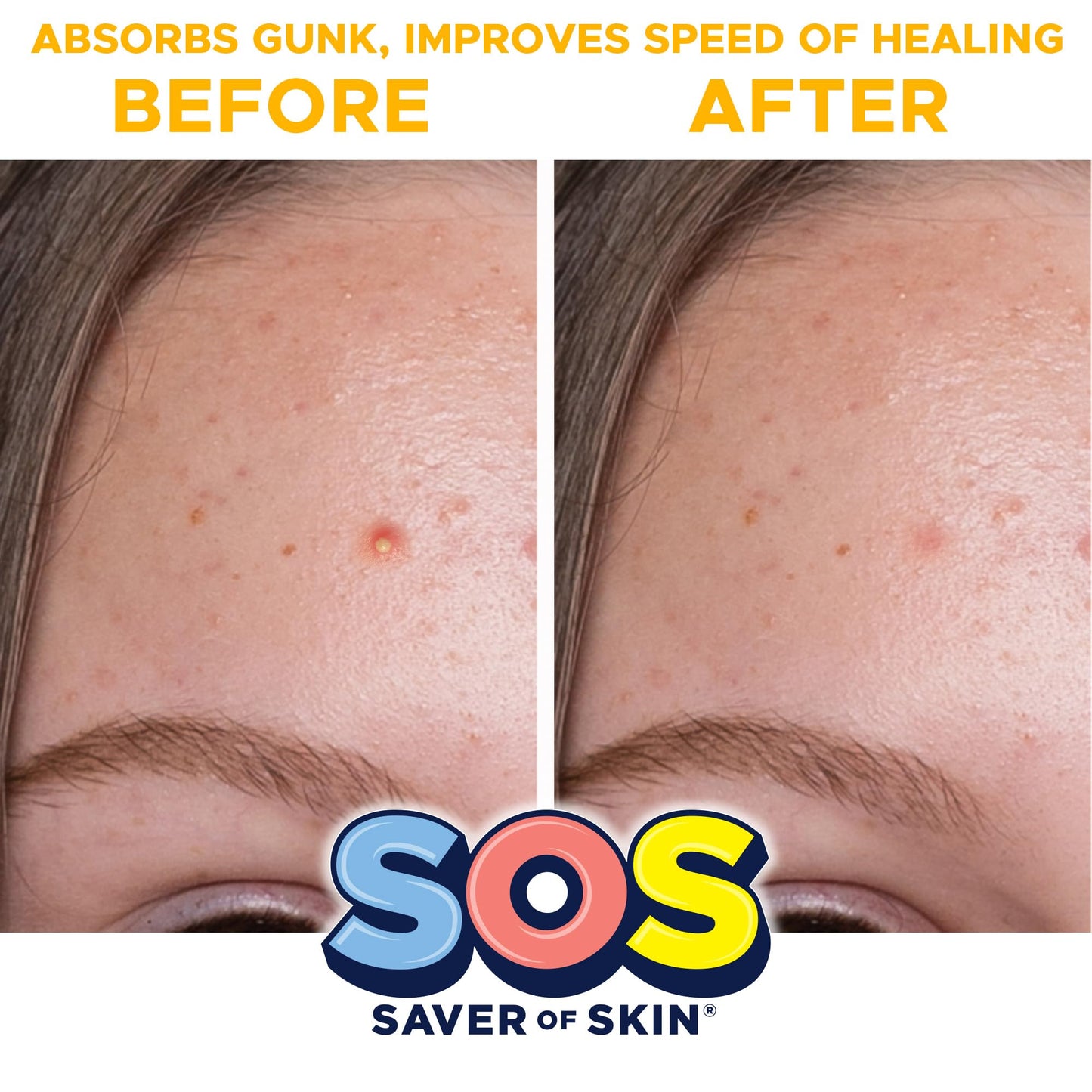 SOS SAVER OF SKIN™, Blemish Patches, Fast Working Hydrocolloid Acne Patches for Covering Pimples, Zits, and Blemishes on Face and Skin, Absorb Fluids, Latex Free, Vegan (80, Transparent)