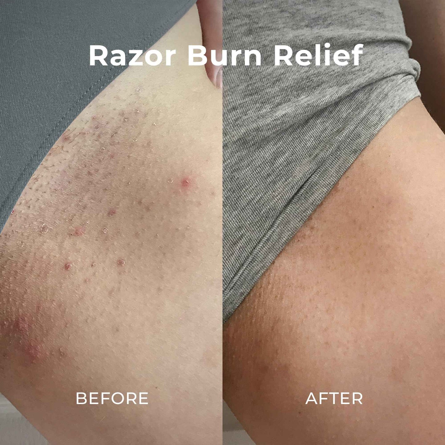 Miami Beach Bum, Bum + Body Cream Daily Moisturizer For Total Skin Health, Body Acne Treatment, Razor Bumps, Keratosis Pilaris, Ingrown Hairs, Sunburns, Blemishes, Orange 6.7 Fl OZ (Pack of 1)