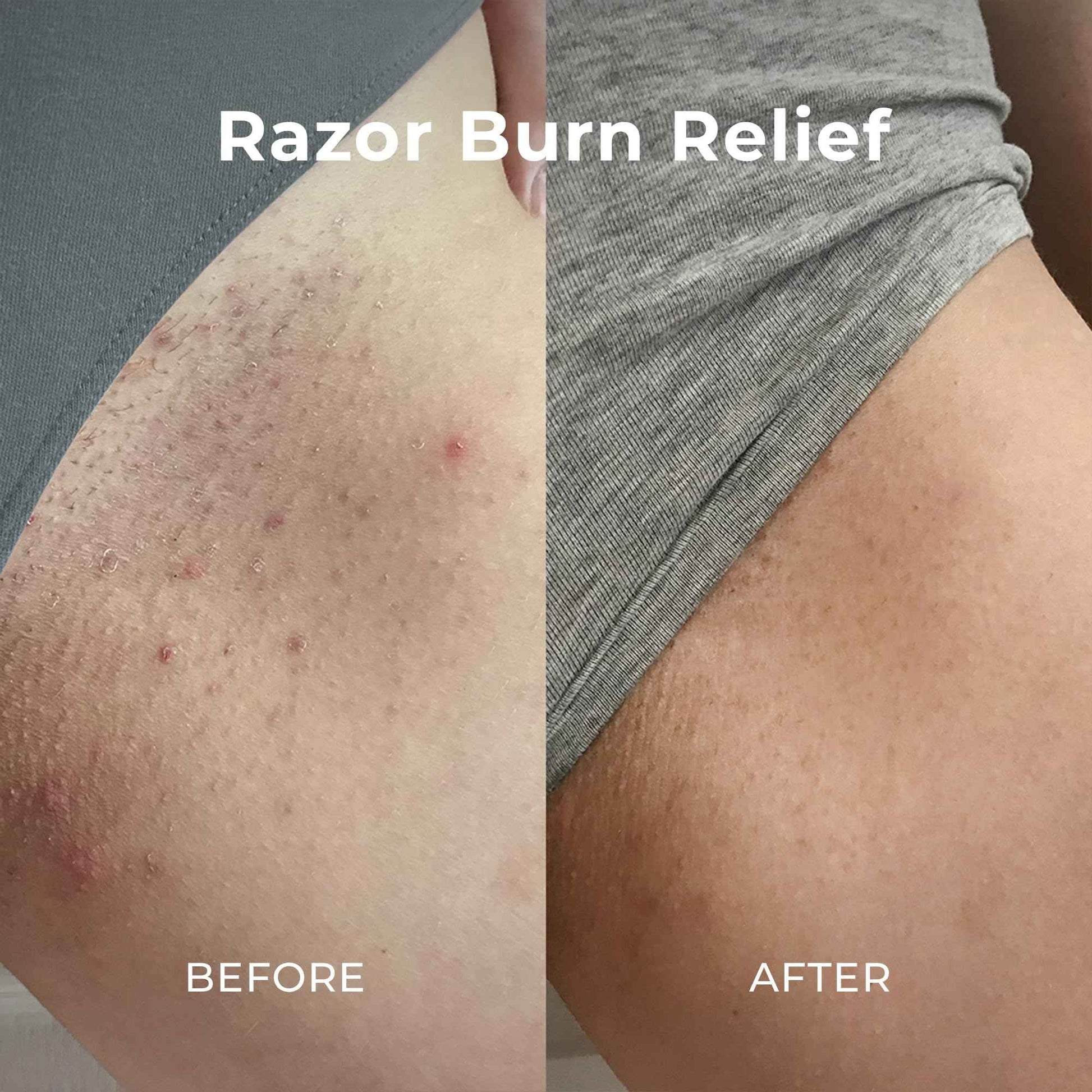 Miami Beach Bum, Bum + Body Cream Daily Moisturizer For Total Skin Health, Body Acne Treatment, Razor Bumps, Keratosis Pilaris, Ingrown Hairs, Sunburns, Blemishes, Orange 6.7 Fl OZ (Pack of 1)