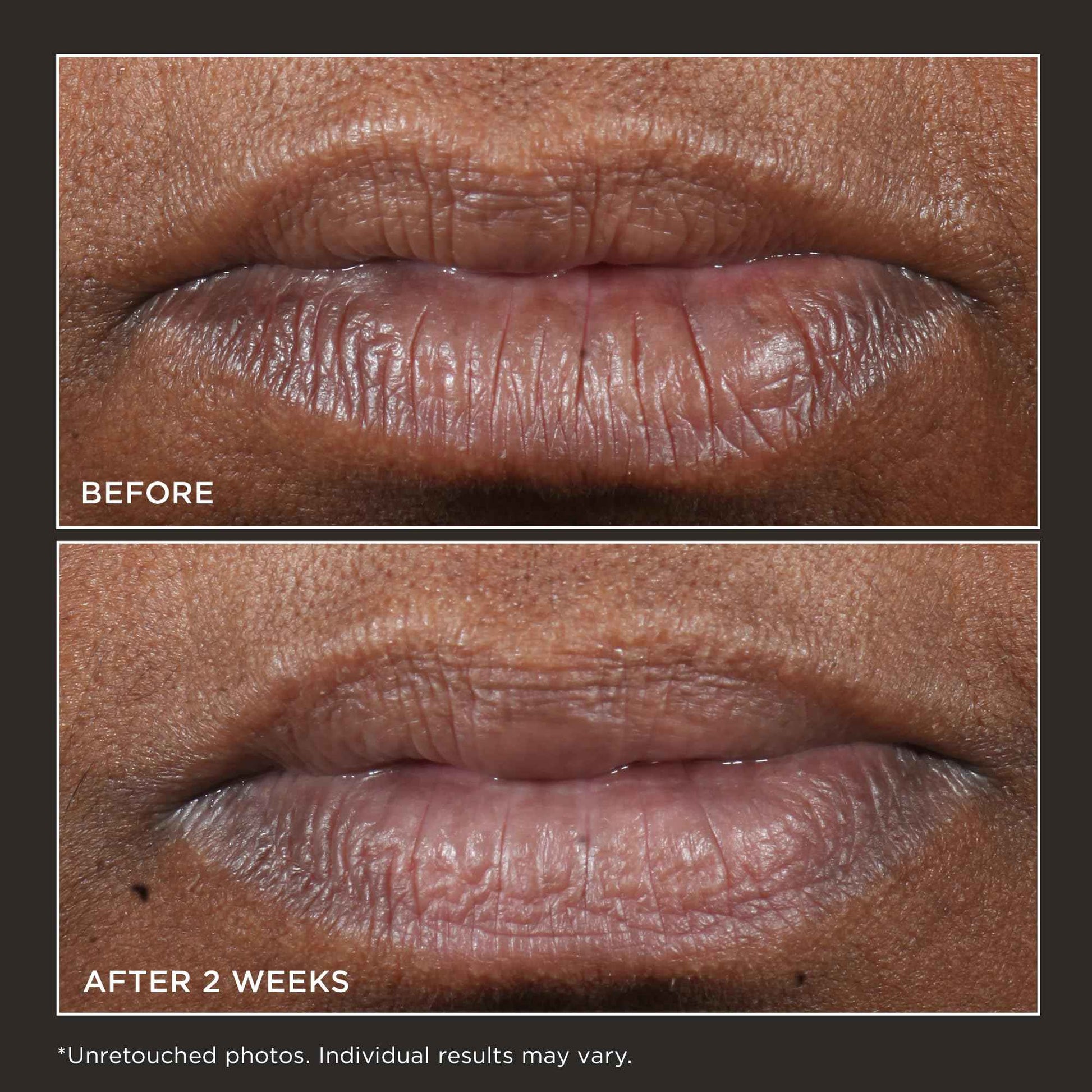 Perricone MD Cold Plasma Plus+ Lip Therapy