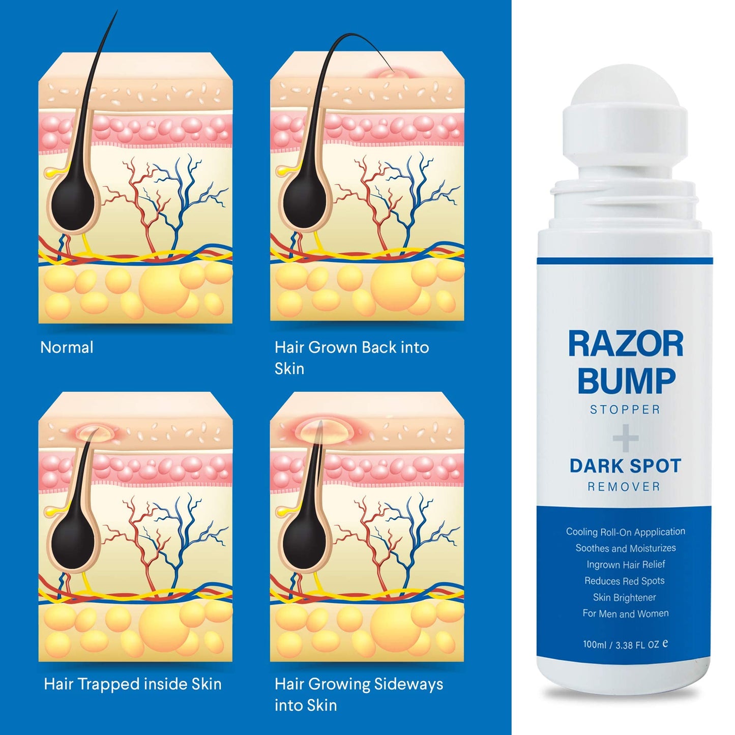Razor Bump Stopper with Ingrown Hair Treatment: Razor Bumps Treatment for Men and Women, After Shave Solution for Ingrown Hairs and Razor Burns, Roll on Applicator- 3.38 Fl Oz
