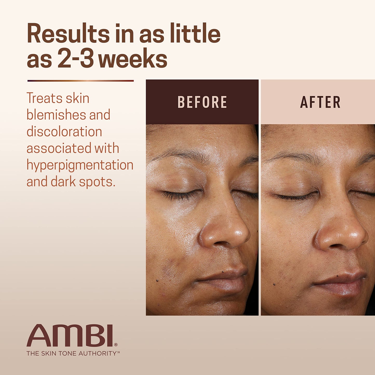 Ambi Even & Clear Fade Cream, Hydroquinone-free, Hyperpigmentation Treatment, Dark Spot Corrector, Results In As Little As 4 Weeks, Niacinamide, Aloe Vera, Vitamin C, 1 Fl Oz