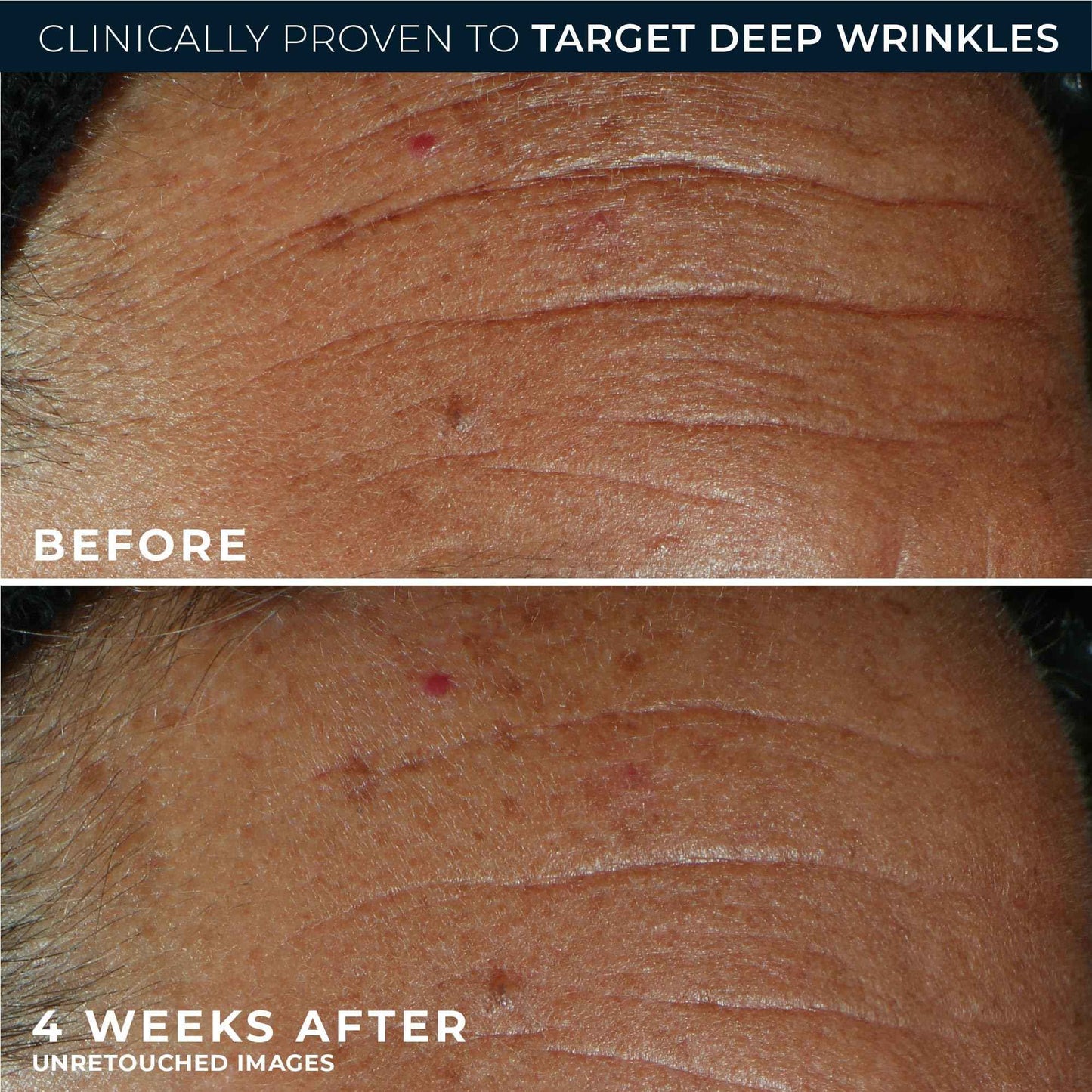 RoC Derm Correxion Fill + Treat Advanced Retinol Serum, Wrinkle Filler Treatment with Hyaluronic Acid for Crow's Feet, 11 Wrinkles, & Laugh Lines, (.5 fl oz) with Retinol Packette (Packaging May Vary)