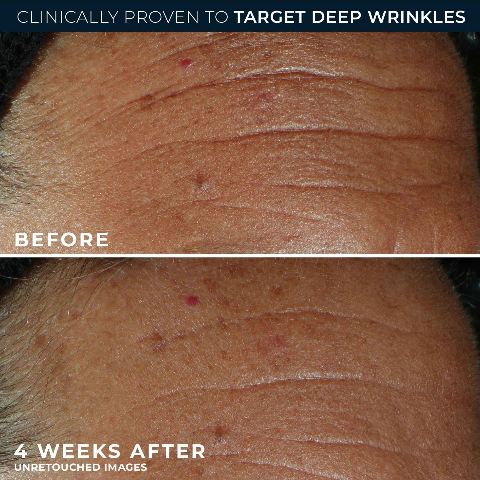 RoC Derm Correxion Fill + Treat Advanced Retinol Serum, Wrinkle Filler Treatment with Hyaluronic Acid for Crow's Feet, 11 Wrinkles, & Laugh Lines, (.5 fl oz) with Retinol Packette (Packaging May Vary)