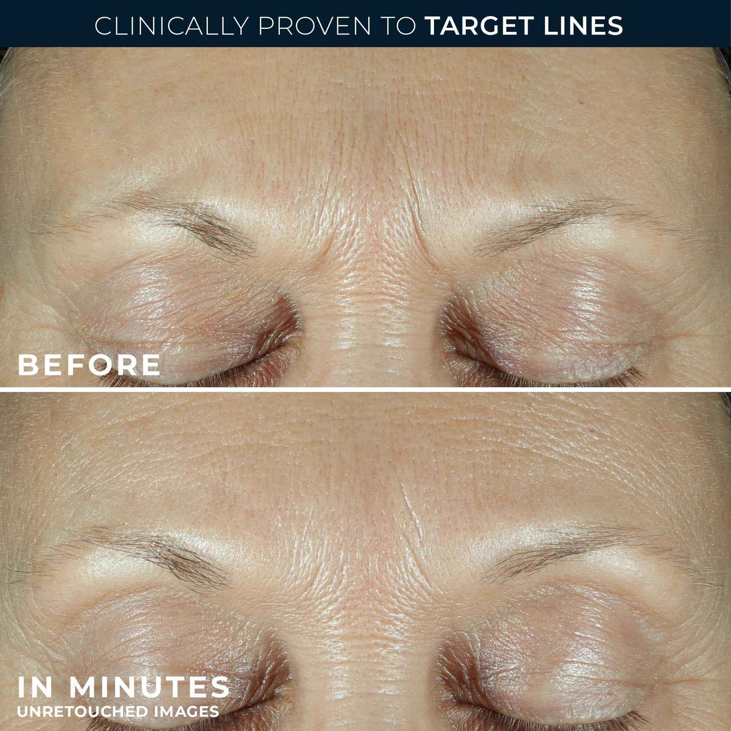 RoC Derm Correxion Fill + Treat Advanced Retinol Serum, Wrinkle Filler Treatment with Hyaluronic Acid for Crow's Feet, 11 Wrinkles, & Laugh Lines, (.5 fl oz) with Retinol Packette (Packaging May Vary)