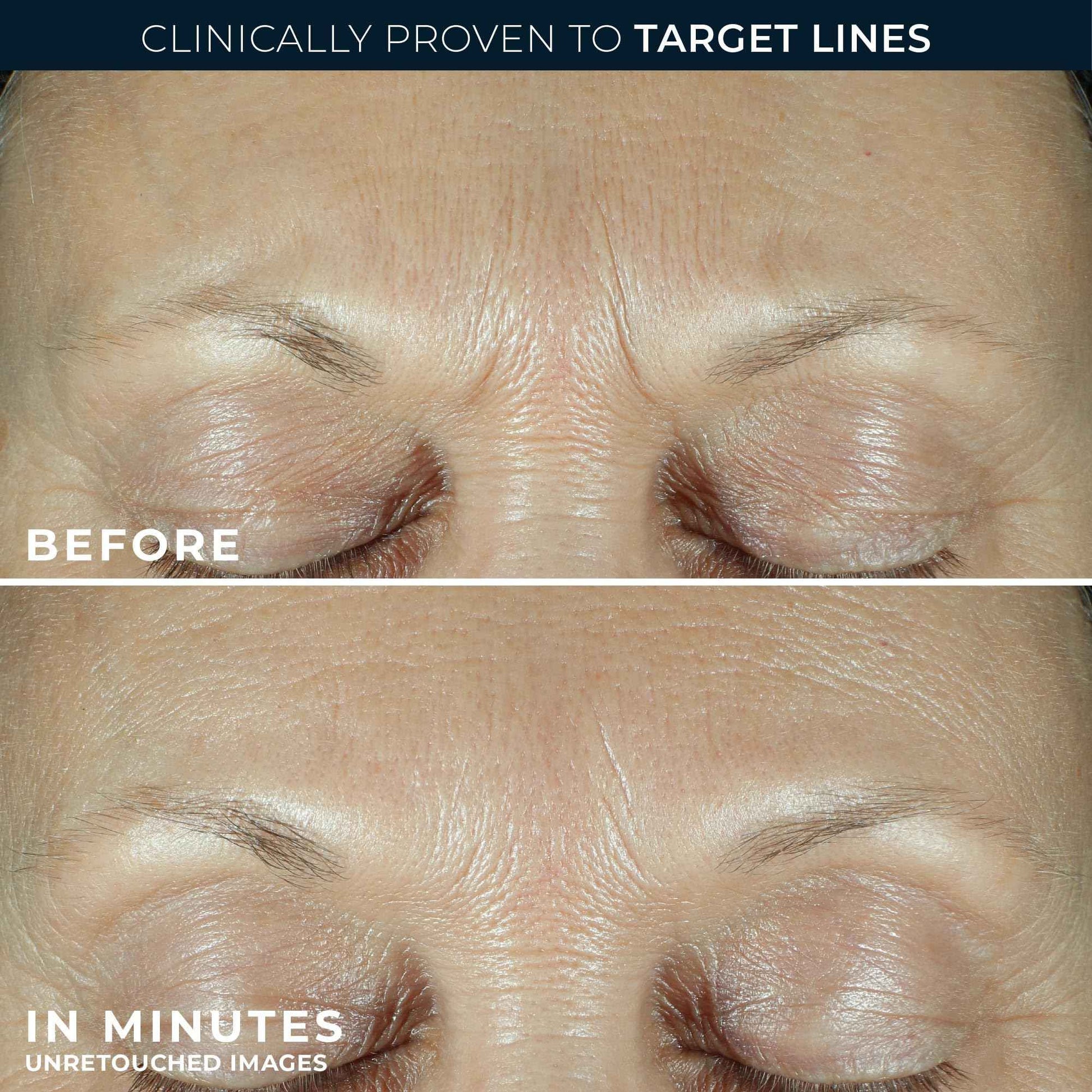 RoC Derm Correxion Fill + Treat Advanced Retinol Serum, Wrinkle Filler Treatment with Hyaluronic Acid for Crow's Feet, 11 Wrinkles, & Laugh Lines, (.5 fl oz) with Retinol Packette (Packaging May Vary)